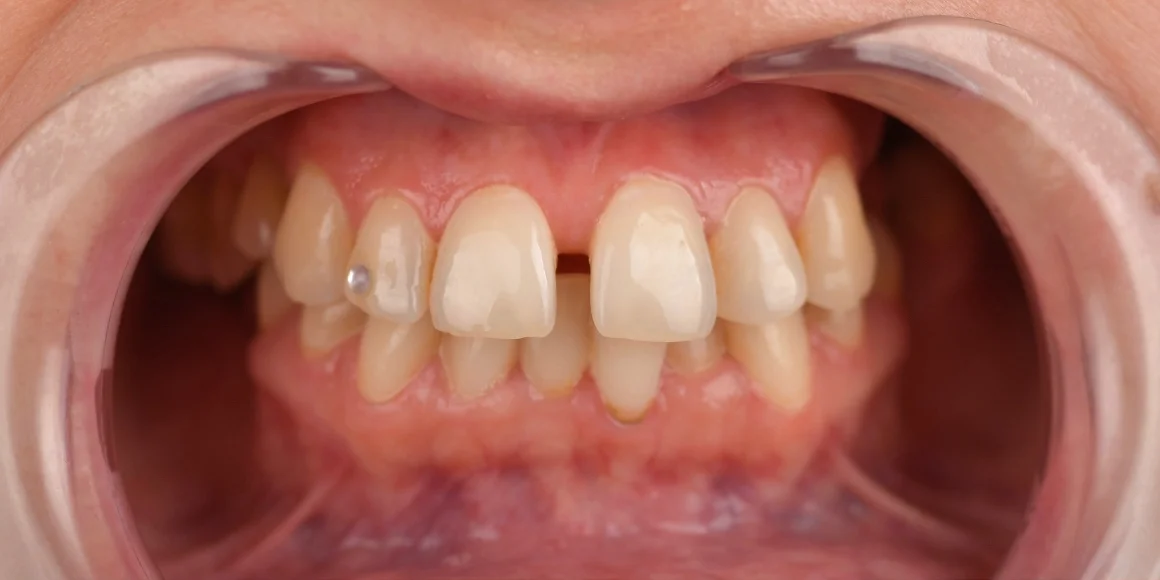 Pre - Hollywood Smile