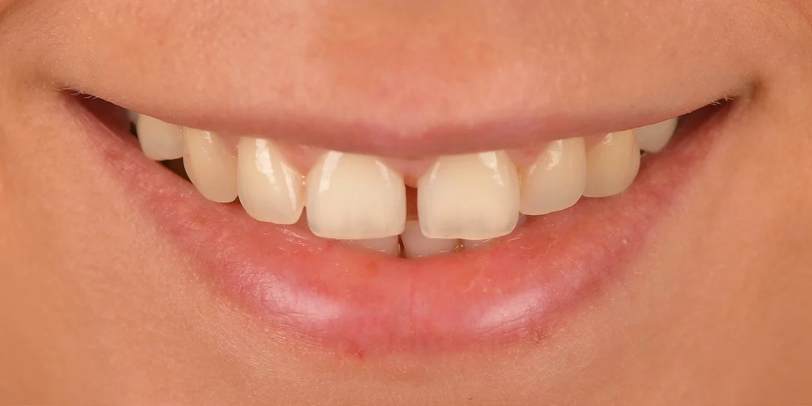 Pre - subperiostalni implantat gornje vilice